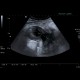 Abscess, Crohn's disease, intra-abdominal abscess: US - Ultrasound